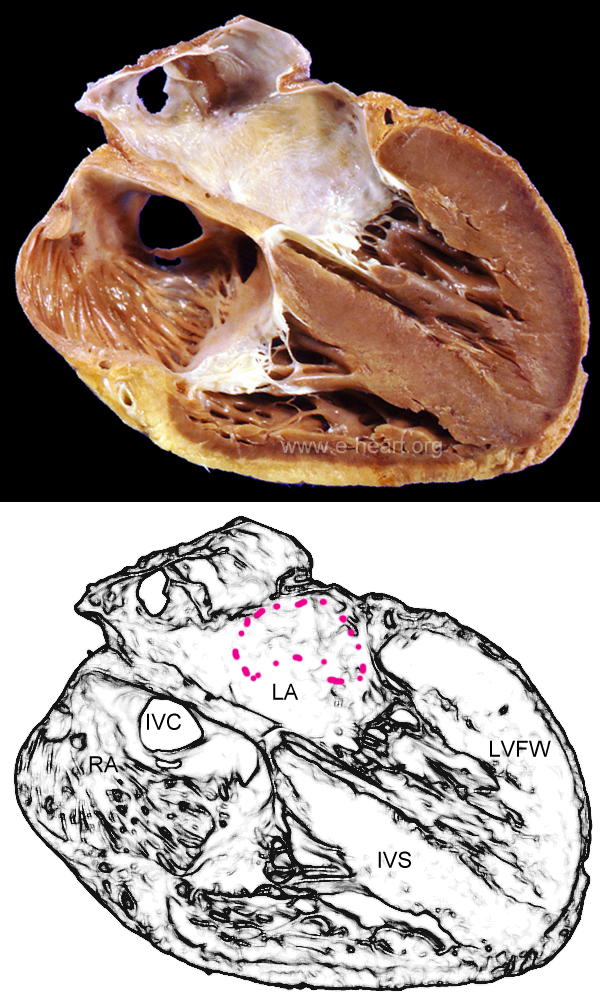 Amyloid 4 chamber view gross